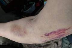 WEEK 0: Pre-Surgery