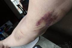 WEEK 0: Pre-Surgery