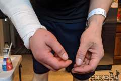 WEEK 1: Post-Surgery Swelling