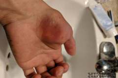 WEEK 6: Left hand injury (opposite arm)