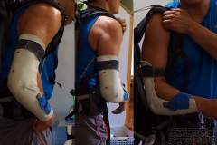 Week 8: last week of splint use